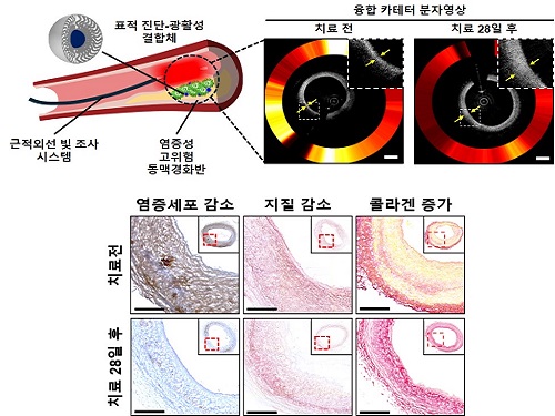 기계공학과 유홍기 교수 연구팀, 빛으로 동맥경화반 동시 진단 및 치료 기술 개발 이미지