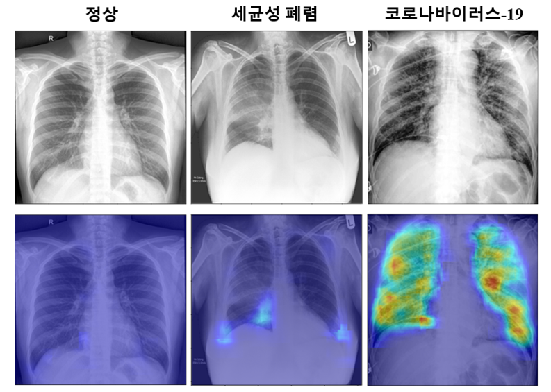 그림 1. 제안하는 코로나19 진단 알고리즘을 통해 얻은 코로나19 확률 분포 특징 지도의 예