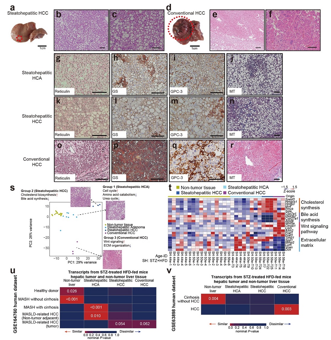 그림 3. 대사이상 지방간 질환 마우스 모델에서 발생한 간세포암과 대사이상 지방간 질환 환자에서 발생한 간세포암의 비교분석. 대사이상 지방간 질환 마우스 모델에서 발생한 간 종양은 사람에서 발생한 간세포암과 조직학적으로 유사 (a-r). 마우스 모델 간 종양의 전사체를 분석해 본 결과 대사이상 지방간 질환 환자에서 발생한 간세포암과 유사 (u).