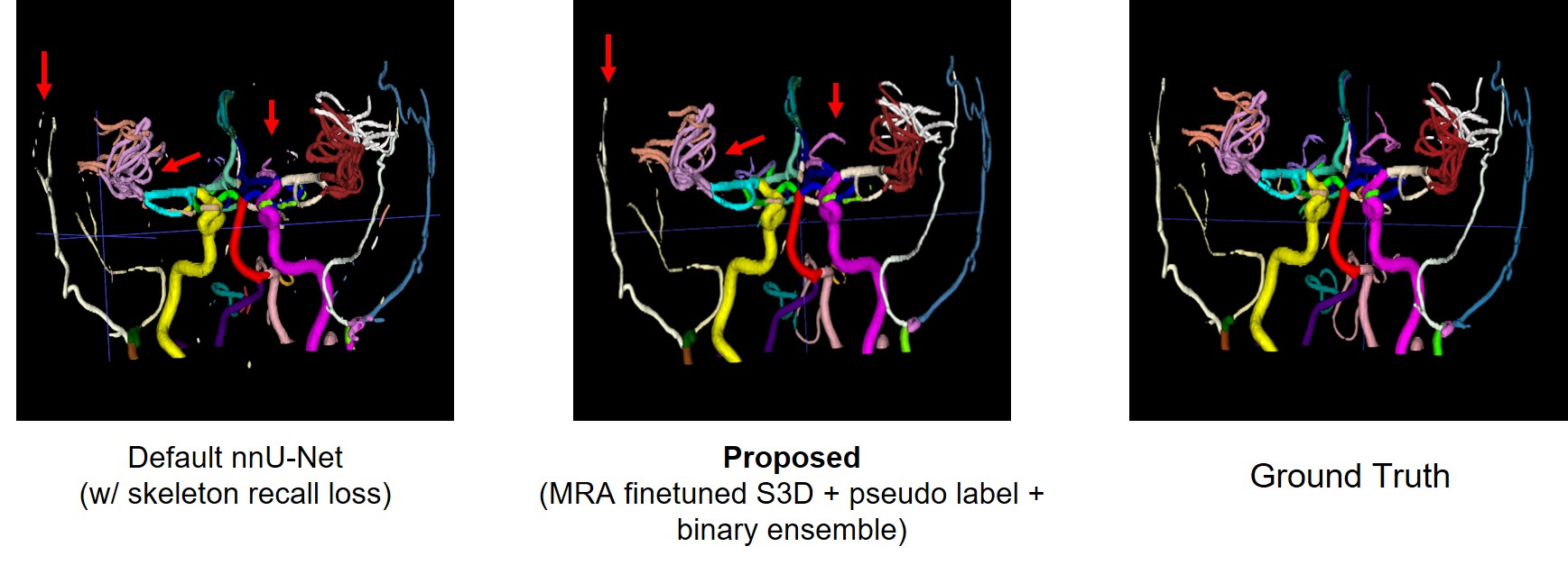 MRI 뇌혈관영상에 대한 segmentation 결과 